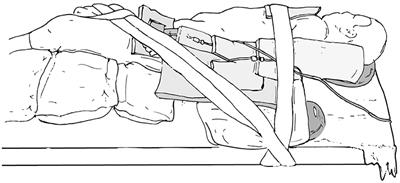 Robotic-Assisted Urologic Surgery in Infants: Positioning, Trocar Placement, and Physiological Considerations